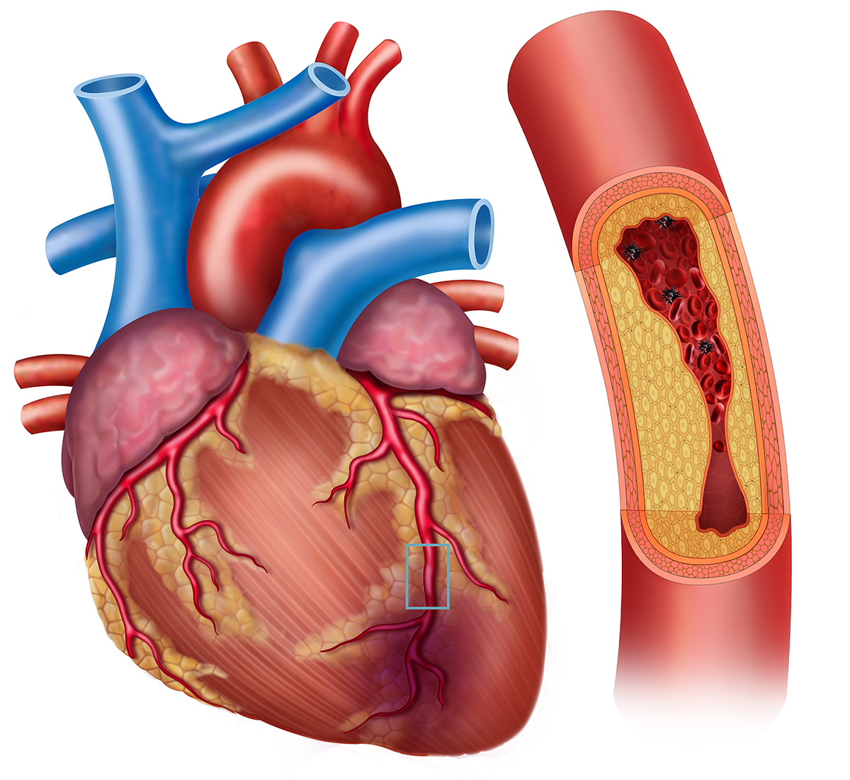 Artery_Plaque_Heart1_2 Artery_Plaque_Heart1_2