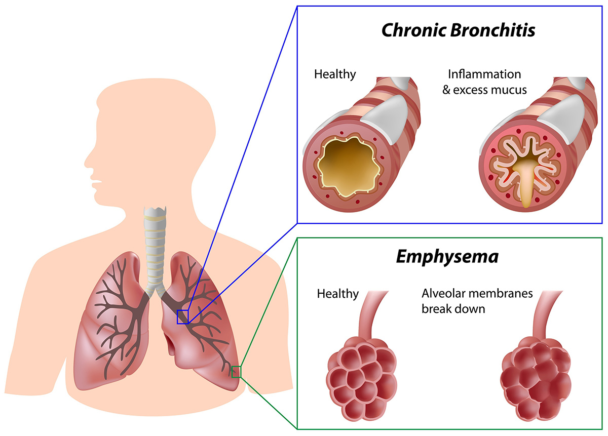 COPD_2_1